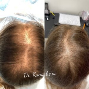 Восстановление волос Regenera Activa-3