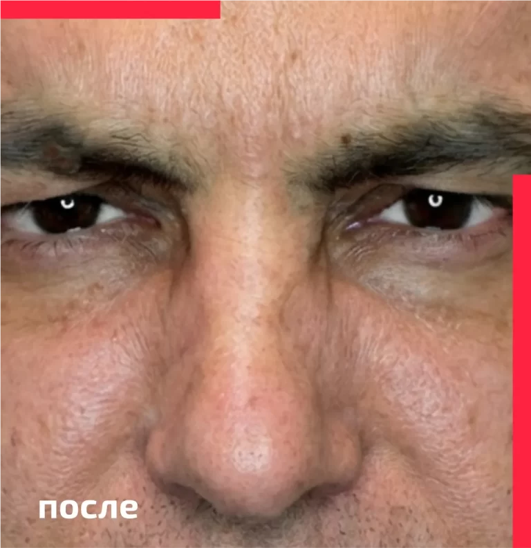 Botulinum toxin therapy for men after