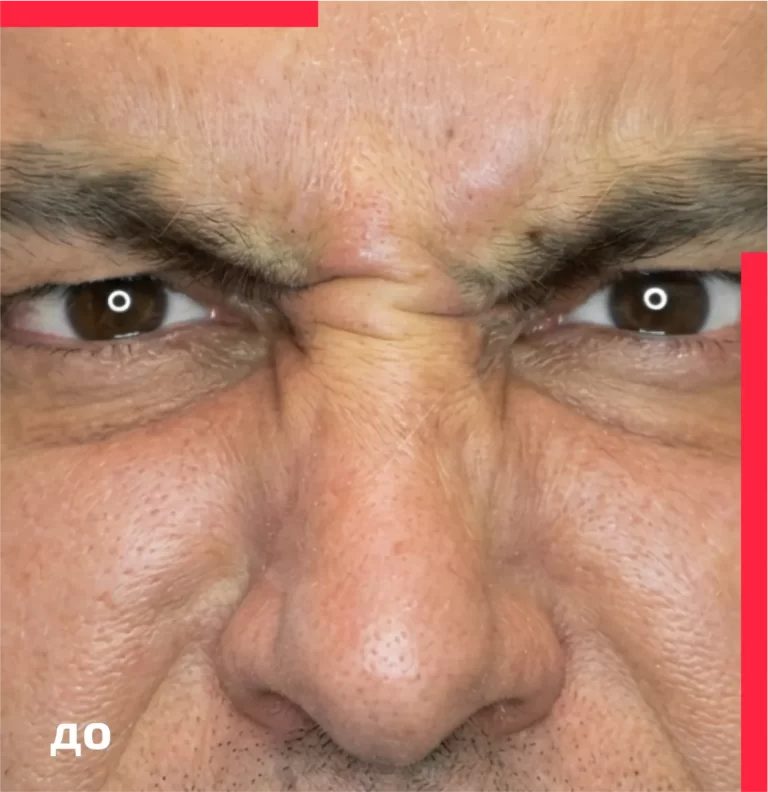 Botulinum toxin therapy for men before