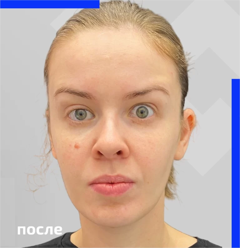 Correction of facial asymmetry after