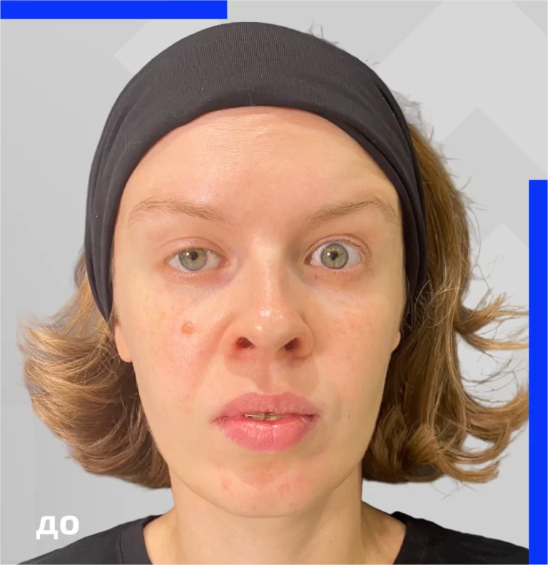 Correction of facial asymmetry before