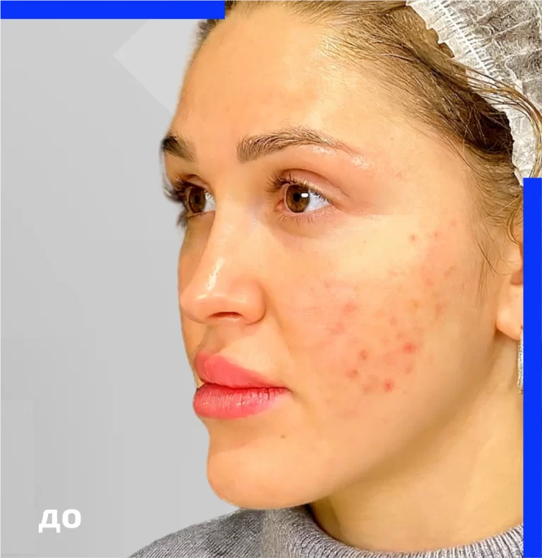 akne_before
