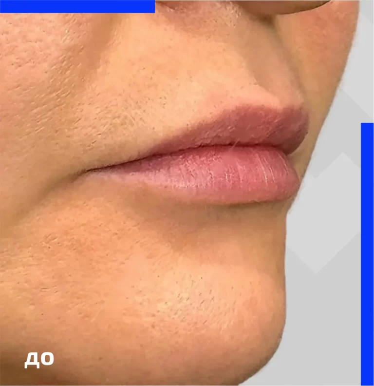 belotero_kult_before