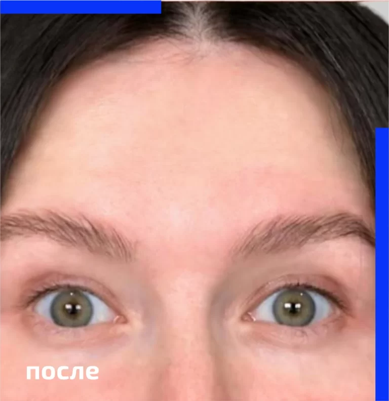 botulinum_therapy_after