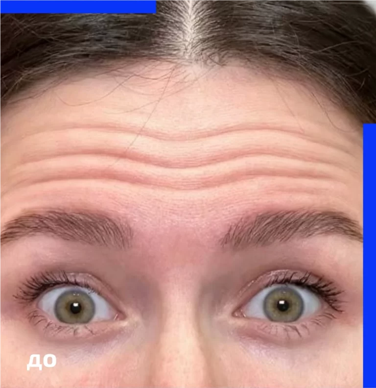 botulinum_therapy_before