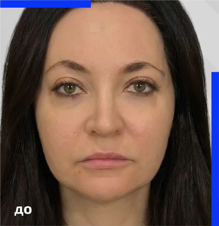 morpheus_galb_before